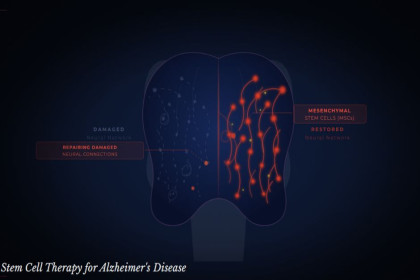 Stem Cell Therapy for Alzheimer's Disease