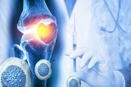 Stem Cell Therapy for Osteoarthritis